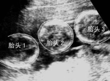 香榧子怎么吃对人体有何益处 孕妇可以吃吗